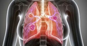 Restrictive Lung Disease: Here's What You Need To Know