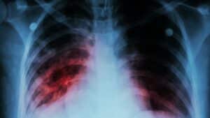 Scarring Of The Lungs And Pulmonary Fibrosis