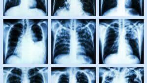 What Is the Life Expectancy for Bronchiectasis